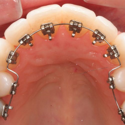 Lingual-Ortodonti Lingual-Ortodonti